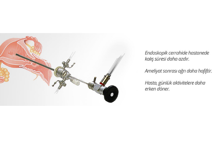 Endoskopik cerrahi nasıl olur