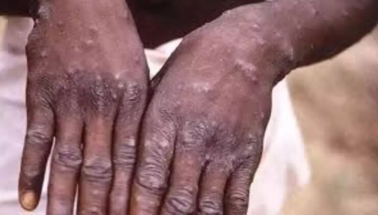Zimbabve ve Zambiya’da Maymun Çiçeği Vakaları Tespit Edildi